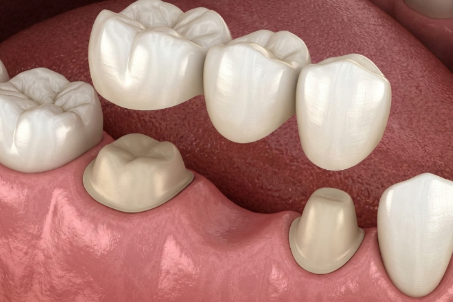 Dental Bridges for Missing Teeth