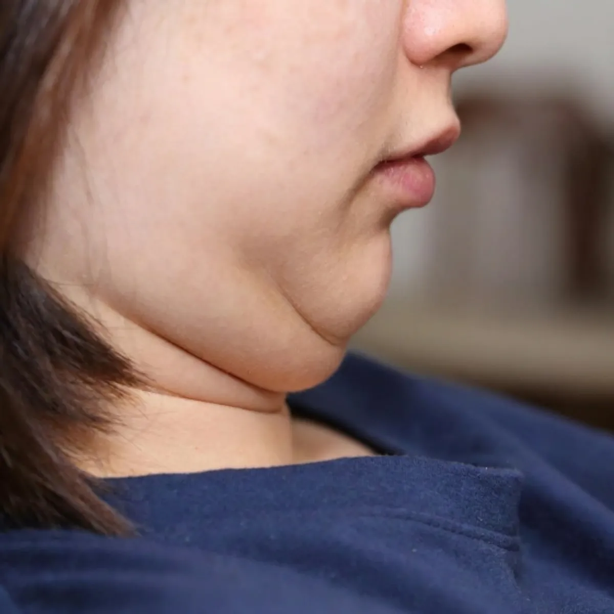 Double Chin
