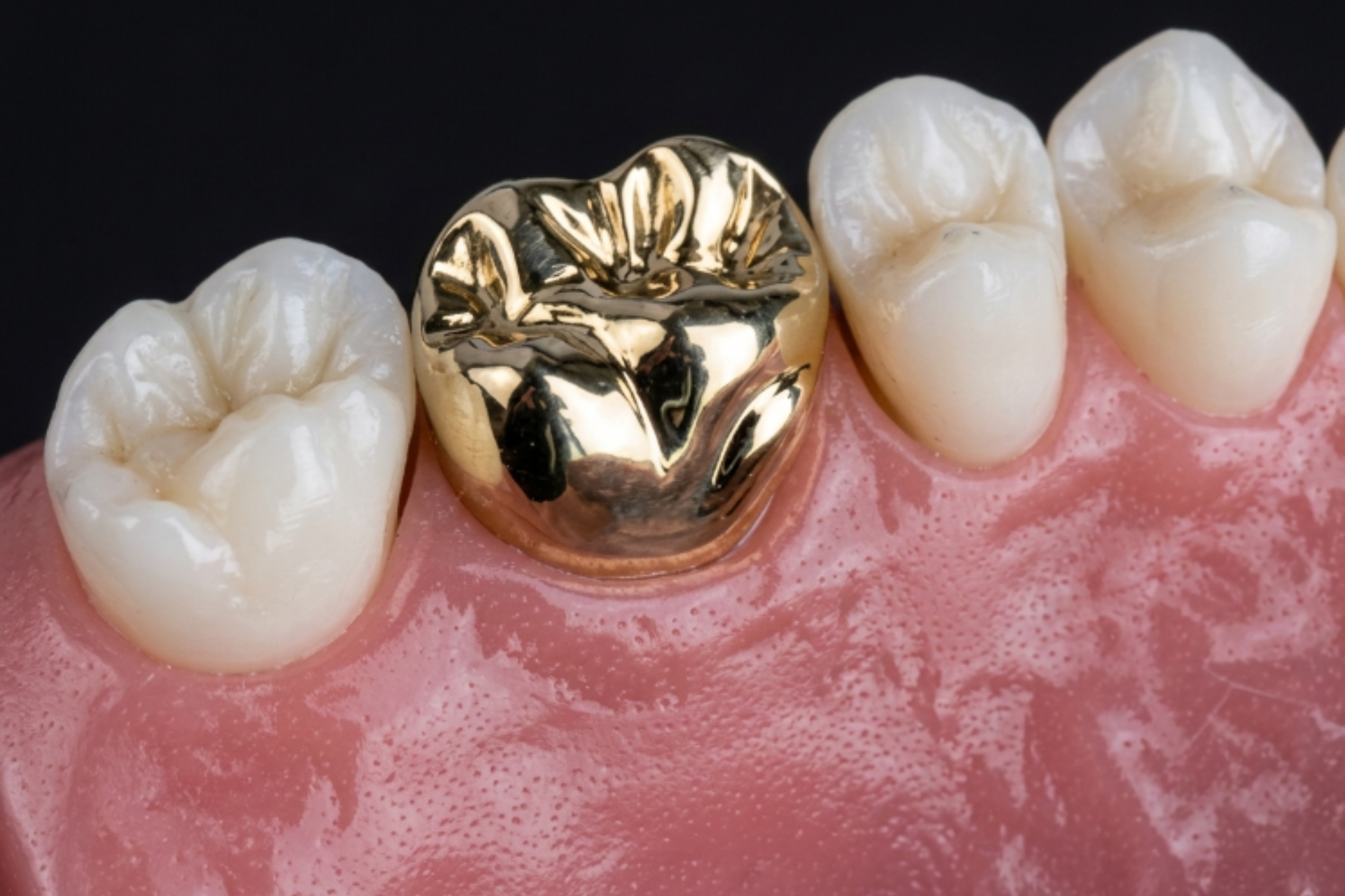 Porcelain-Fused-to-Metal Crowns