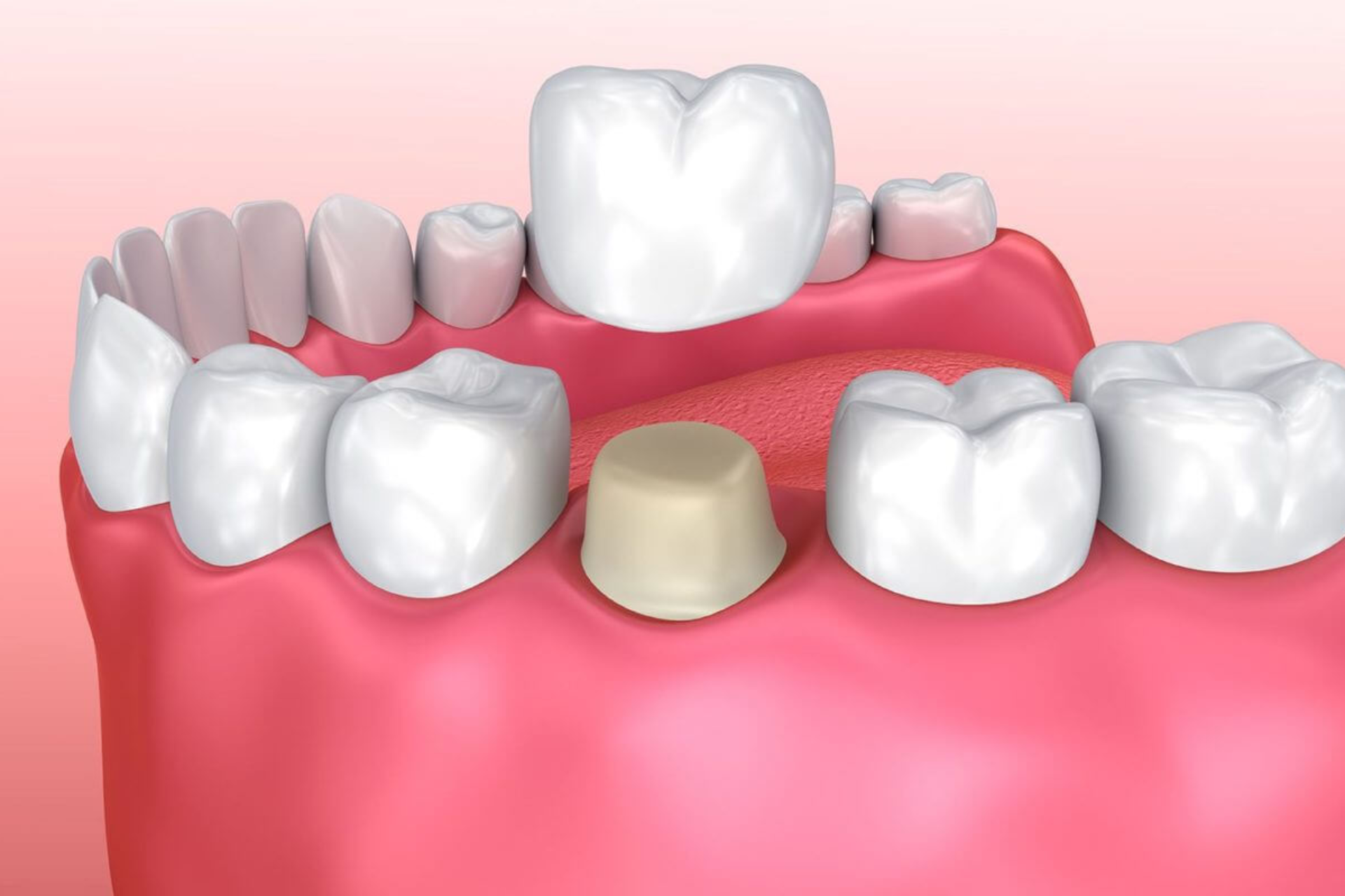 Porcelain and Ceramic Crowns