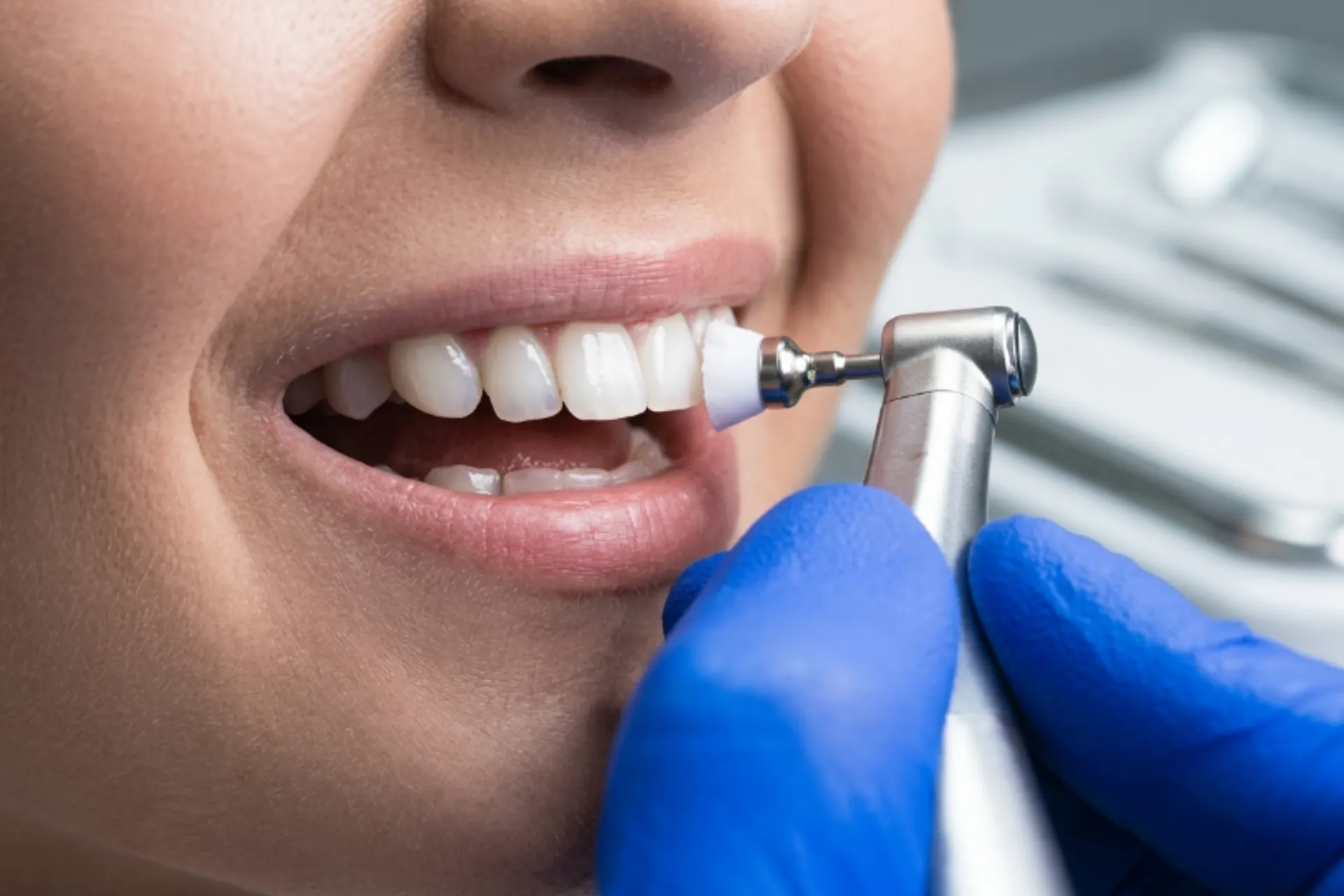 Whitening for Sensitive Teeth