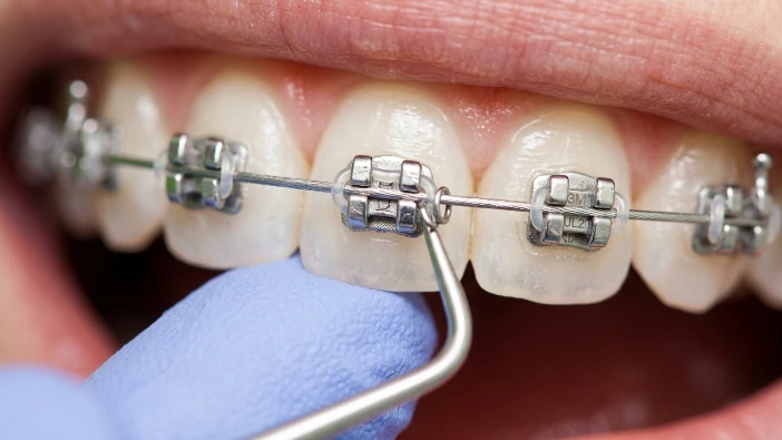 What is Stage 4 of Braces? Understanding the Final Phase of Your Orthodontic Journey